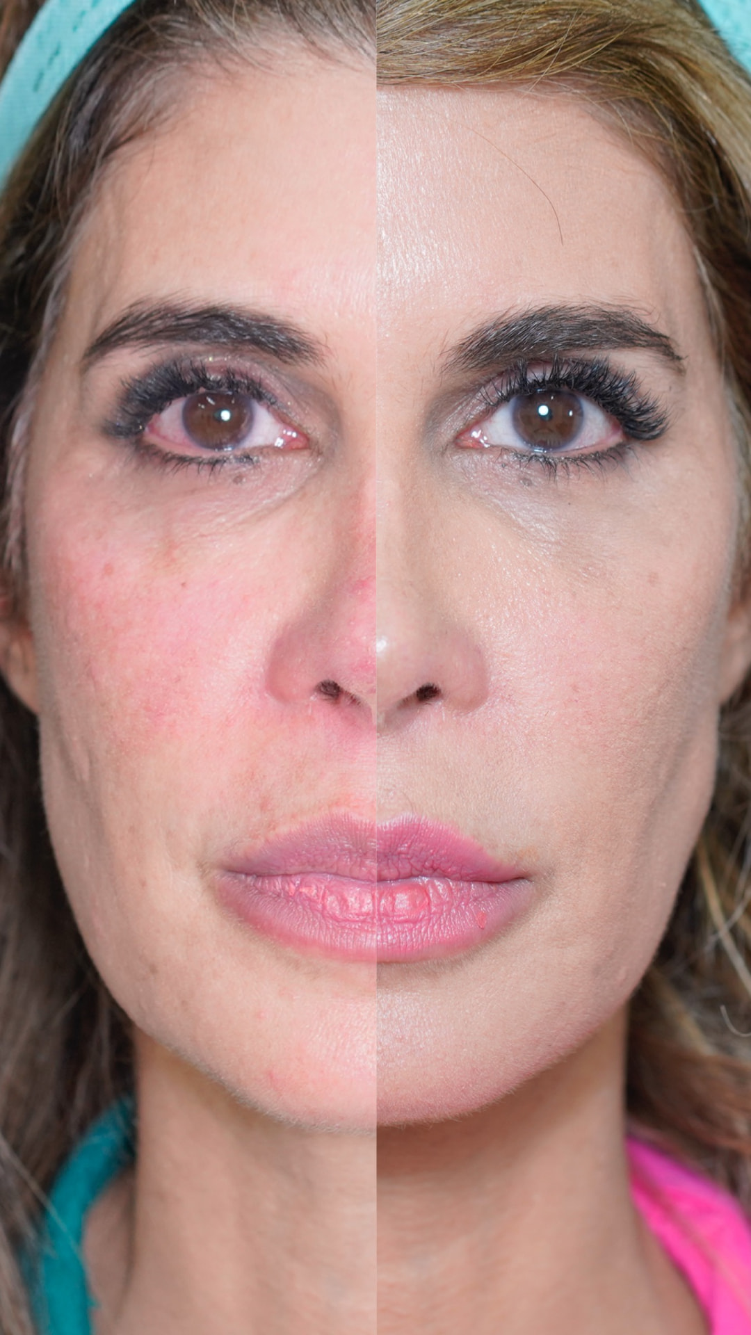 Split-face comparison: left side before Sculptra, BBL Heroic and Moxi; right side the same left side one week after treatment, showing improved skin tone and texture